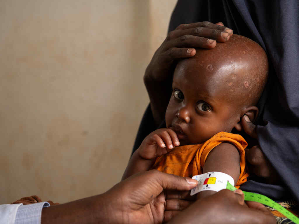 한 어린이가 영양실조 진단을 받고 있습니다.