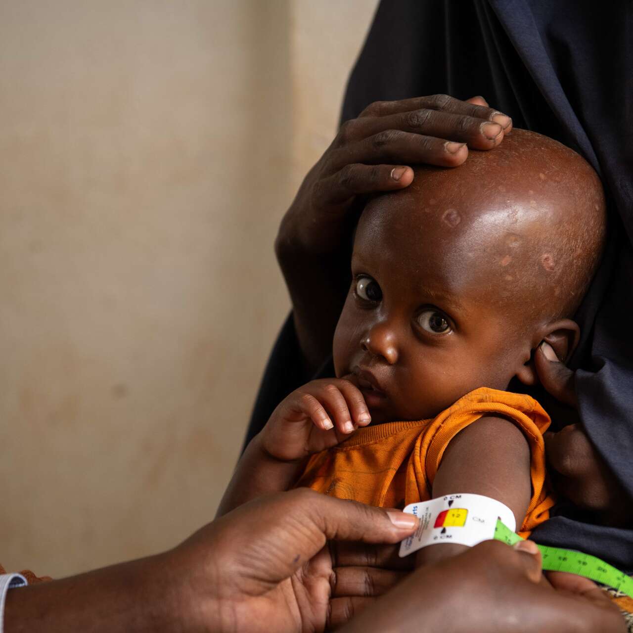 Two-year-old Mowlid eats a high protein peanut paste, also known as ready-to-use therapeutic food (RUTF), as treatment for his severe acute malnutrition. As part of our simplified approach, the IRC recommends providing RUTF as the primary treatment product for all children diagnosed with acute malnutrition.
