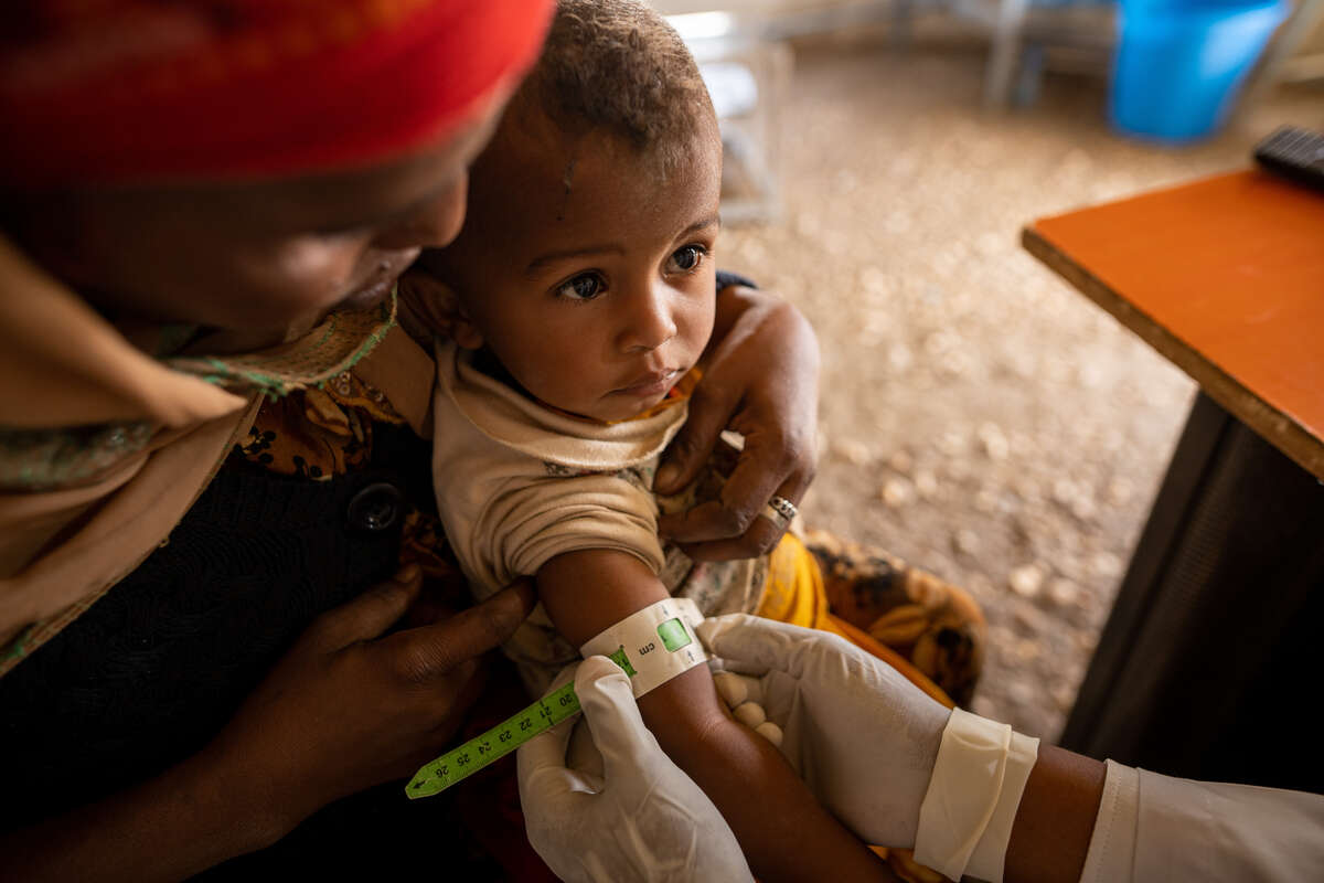 Ett litet barn undersöks för undernäring genom att få sin överarm mätt.