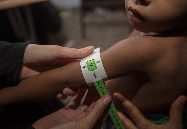 Closeup of a health worker measuring a child's upper arm circumference while checking for signs of malnutrition.